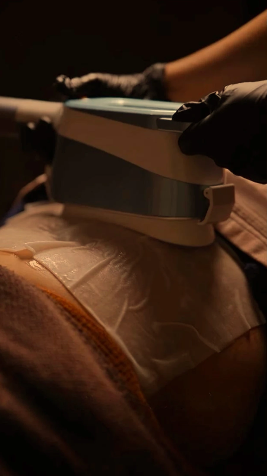 Cryolipolysis